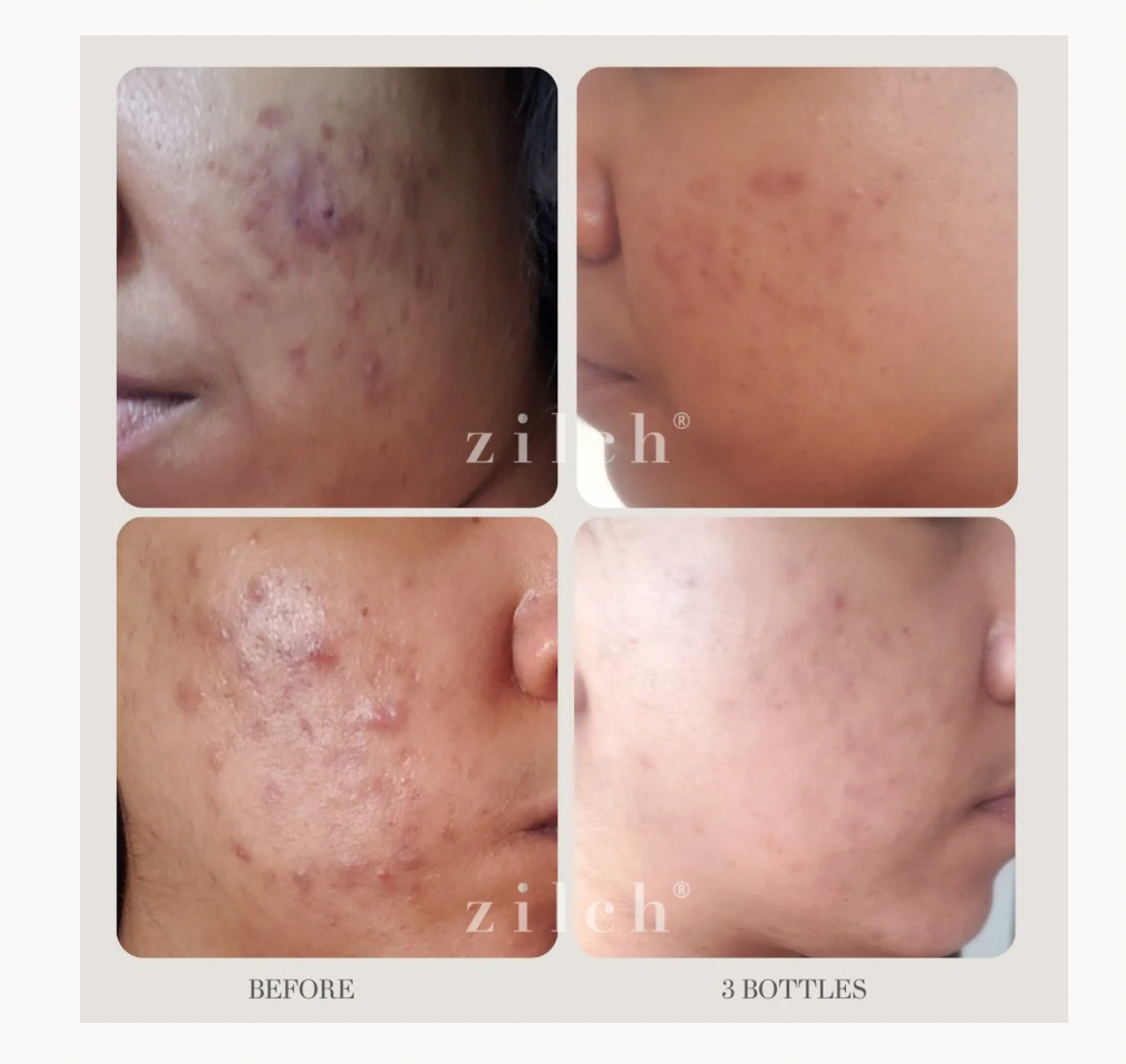 Zilch Acne Suppliments