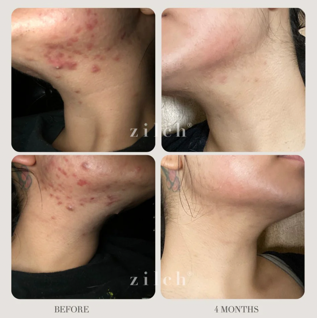 Zilch Acne Suppliments